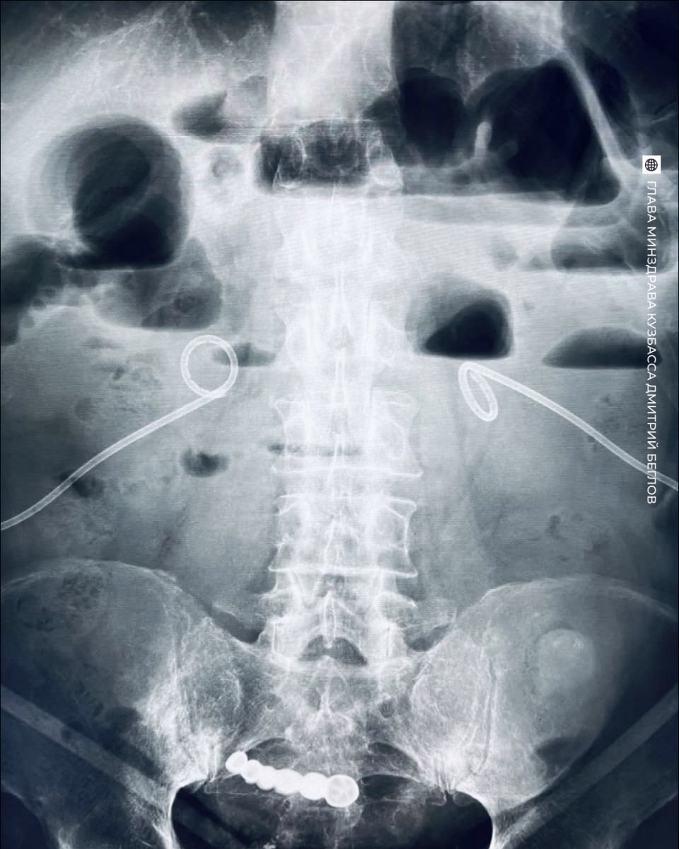 Удивительная история: житель Кемеровской области прожил шесть лет со вставной челюстью в кишечнике