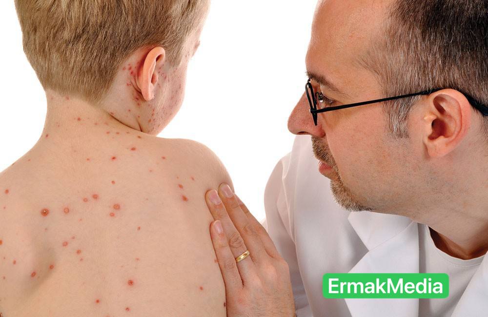 Корь близко…