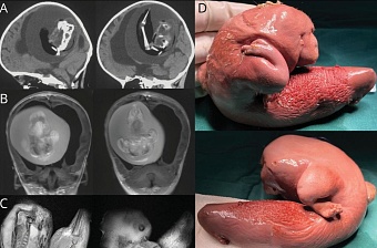 Плод близнеца обнаружили в голове годовалой девочки 
