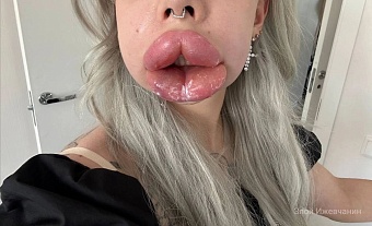 Блогерша Картье Бугатти чуть не умерла из-за процедуры по уменьшению губ