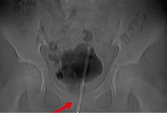 Китайские хирурги удалили градусник из мочевого пузыря 12-летнего мальчика 