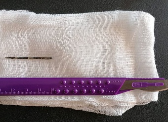 Удивительная выживаемость: женщина из Волгограда прожила почти 20 лет с иглой в животе