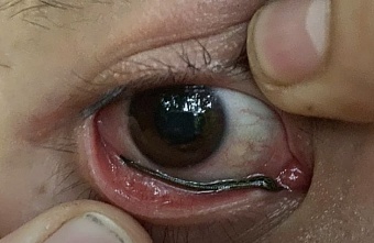 Туристу в Таиланде пиявка заползла в глаз из объектива фотоаппарата