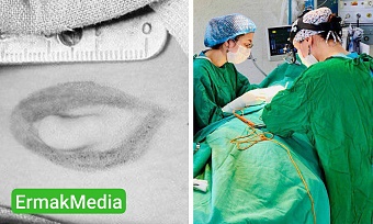 Четырехлетнему ребенку удалили жабры